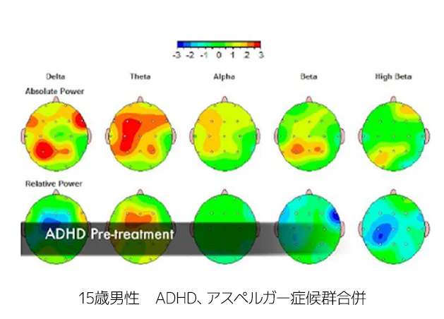 15歳男性 ADHD、アスペルガー症候群合併（脳波の図）