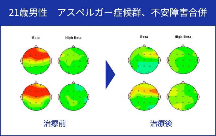 21歳男性 アスペルガー症候群、不安障害合併
