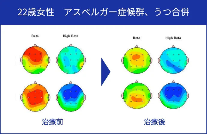 22歳女性 アスペルガー症候群、うつ合併