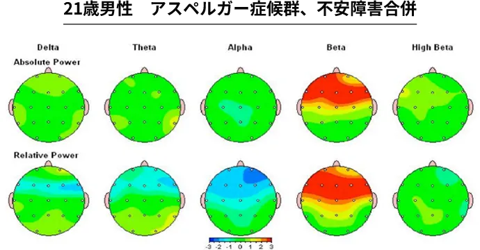21歳男性 アスペルガー症候群、不安障害合併
