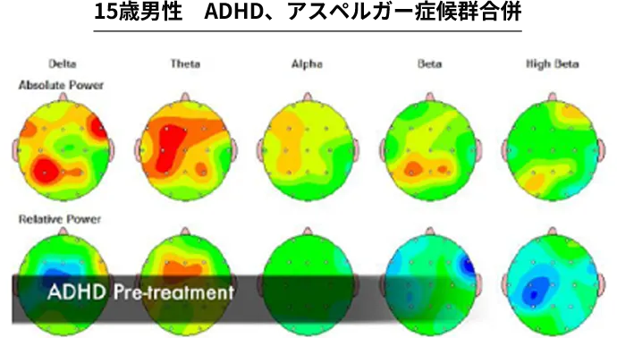 15歳男性 ADHD、アスペルガー症候群合併