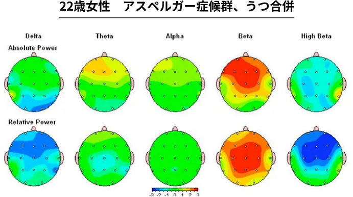 22歳女性 アスペルガー症候群、うつ合併