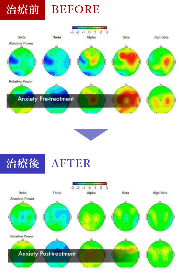 治療前と治療後 β(ベータ)波が減少