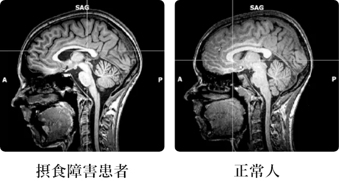 摂食障害患者と正常人の比較