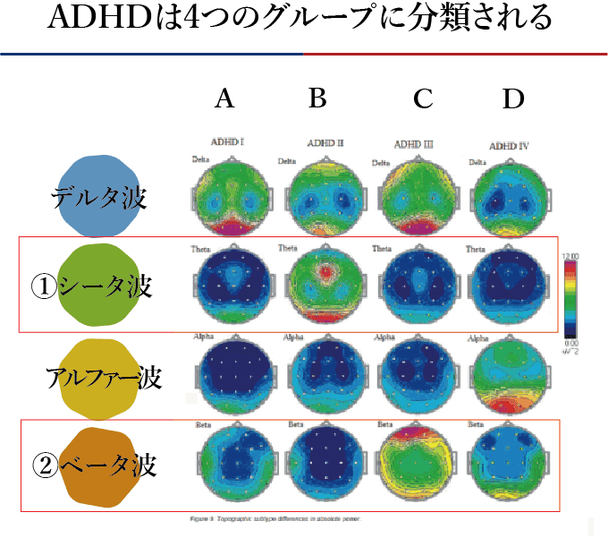 ADHDは4つのグループに分類される