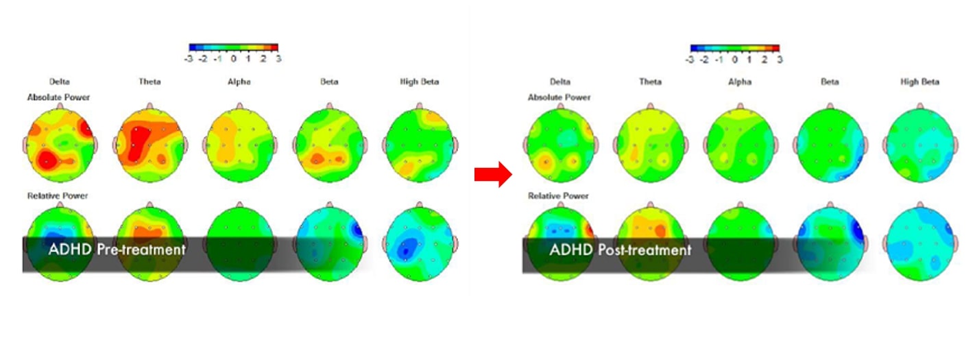 ADHD、アスペルガー症候群合併