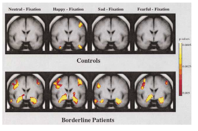 境界性パーソナリティ障害（BPD）患者は相手の表情を捉える時に、扁桃体が過剰反応