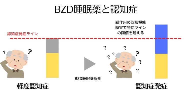 BZD睡眠薬と認知症